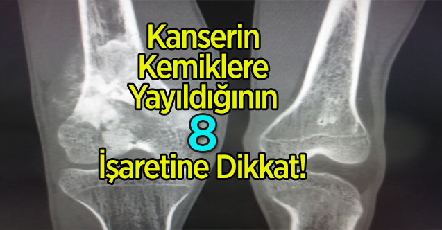 Kanserin Kemiklere Yayıldığının 8 İşaretine Dikkat!